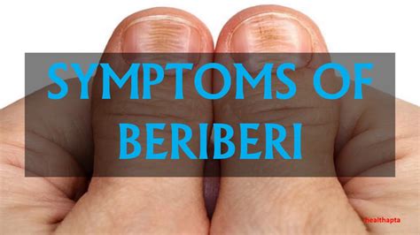 Discover the Startling Symptoms of Beriberi and Take Control of Your Health Today